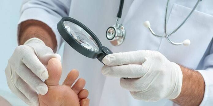 el médico examina la pierna con una verruga en el pie